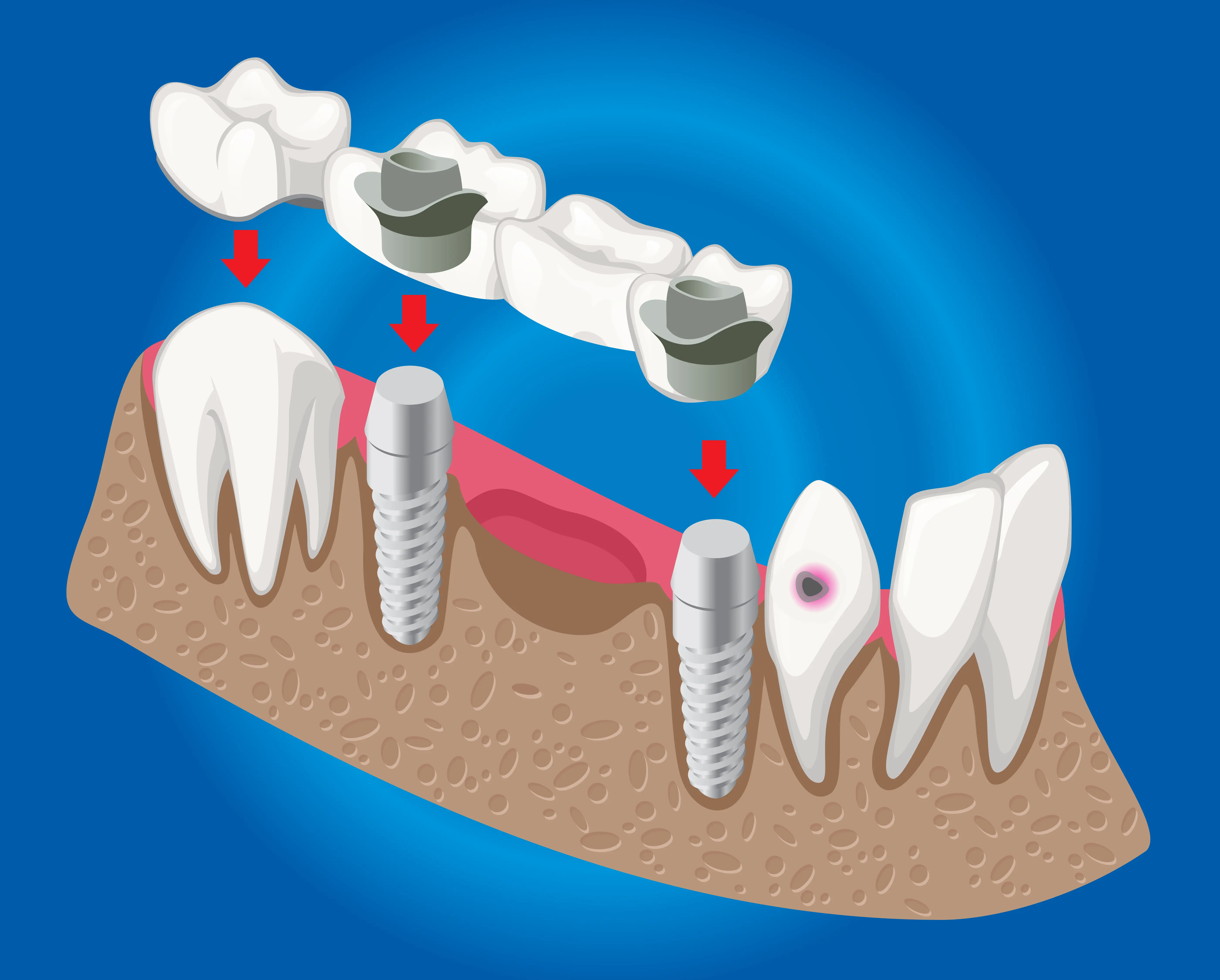 Corona y Puente Dental